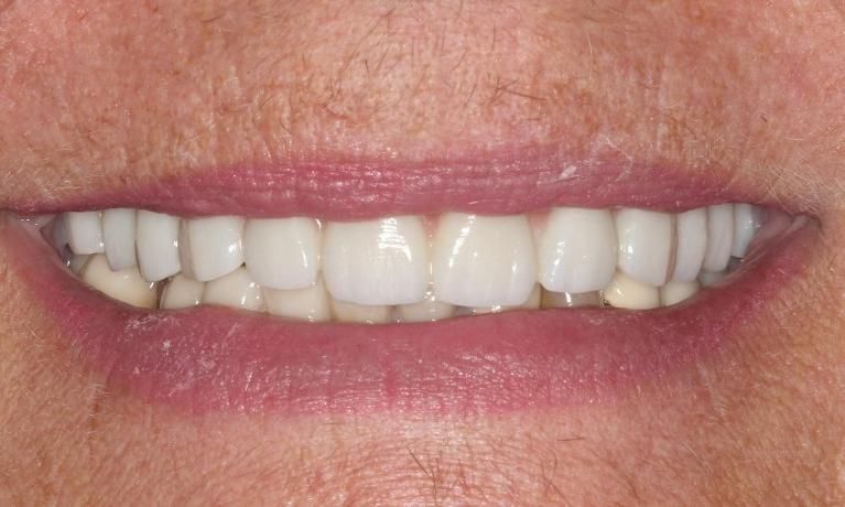 Aftre Upper implant denture