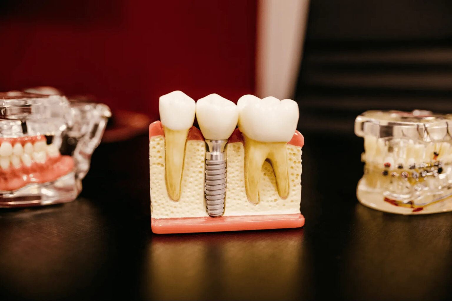 Single Tooth Dental Implants: A Path to a Complete Smile