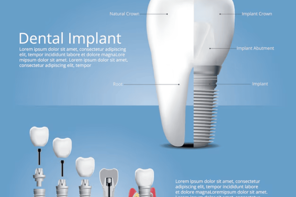 choosing the right tooth replacement a guide to implants, bridges, and dentures